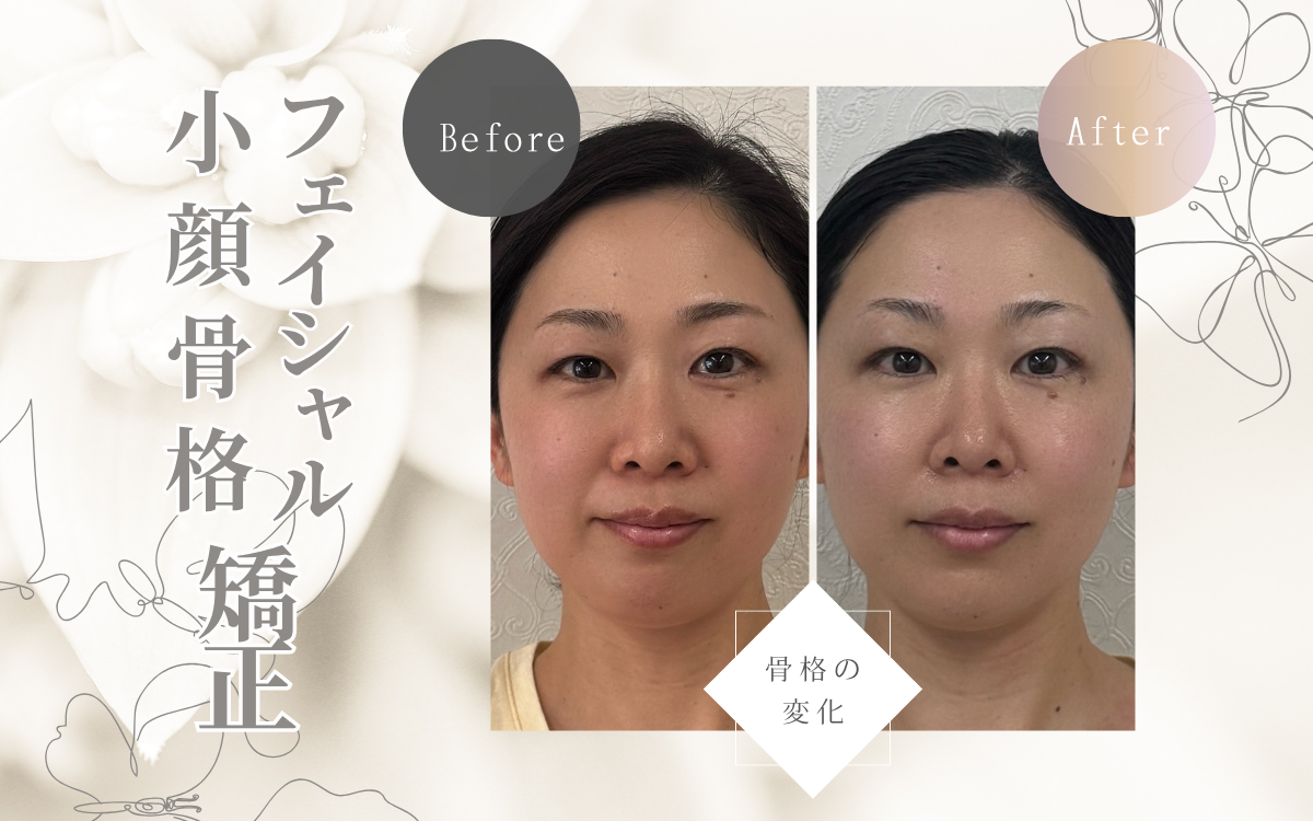小顔矯正でたるみ・ほうれい線改善 | 東京都練馬区の小顔矯正フェイシャルエステサロンPeau Belle poe 