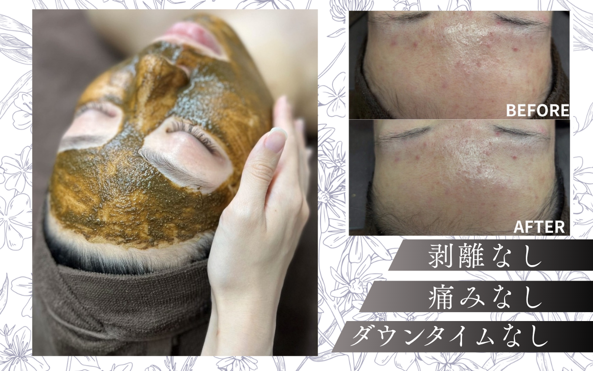 【国産無添加ハーブ使用】ドクターズラインハーブピーリング／繰り返すニキビ・シミ改善